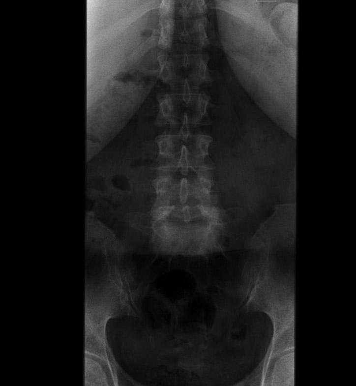 spondylolisthesis