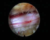 intervertebral disc