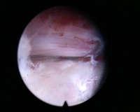 intervertebral disc